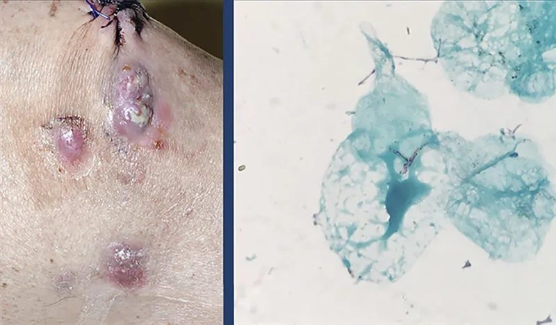 Common Mycoplasma genitalium Symptoms to Know