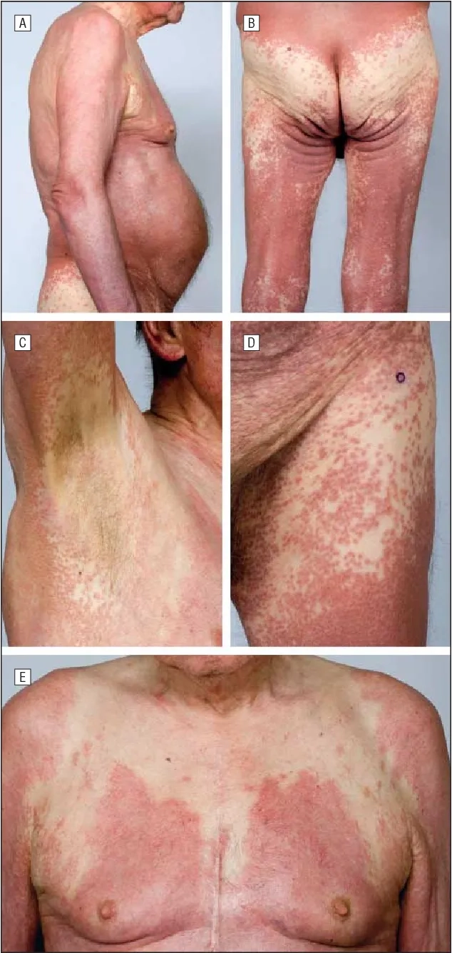 Myelodysplastic syndrome life expectancy in medical statistics