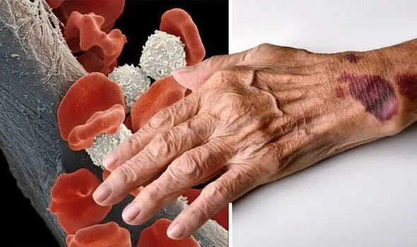 Types of MDS depicted in detailed hematology diagram