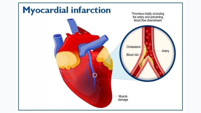 Silent killer effects of myocardial infarction