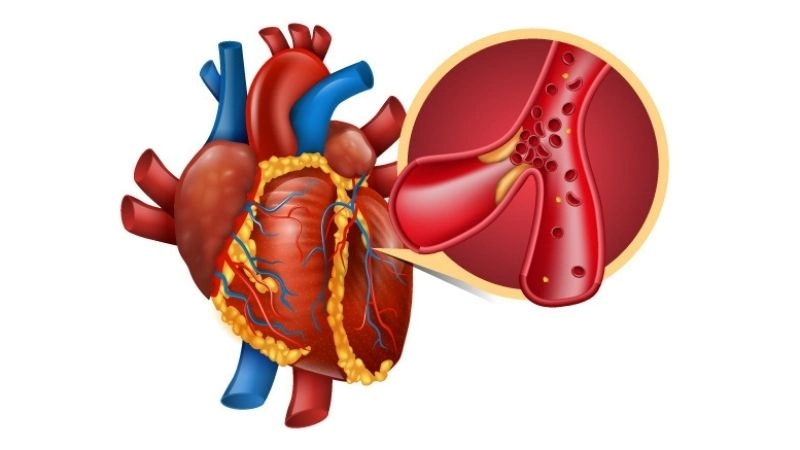 Clear view of acute myocardial infarction meaning