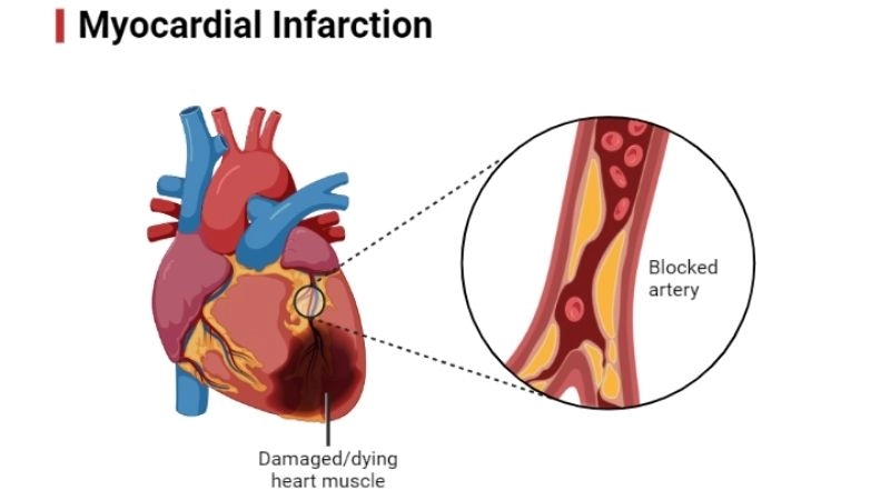 Alarming signs of myocardial infarction symptoms
