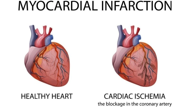 Lifesaving steps for myocardial infarction treatment