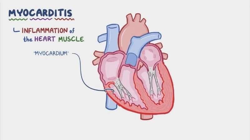 Myocarditis diagnosis accurate methods for early detection