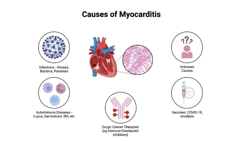 Myocarditis vs heart attack differences in chest pain causes