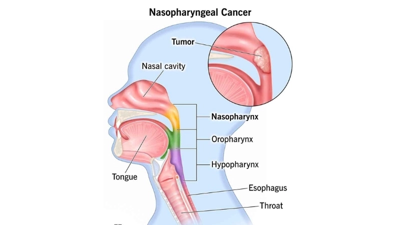 Nasopharyngeal Carcinoma linked to nasopharyngeal carcinoma