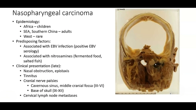 EBV infection often triggers Nasopharyngeal Carcinoma