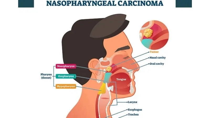 NPC diagnosis often reveals Nasopharyngeal Carcinoma