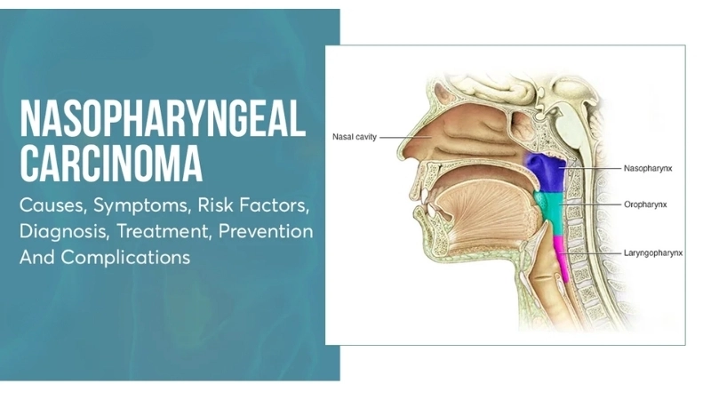 Nasopharyngeal Carcinoma symptoms differ from nasal cavity cancer