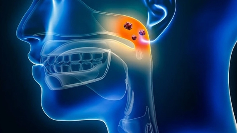 Some throat cancer cases connect to Nasopharyngeal Carcinoma