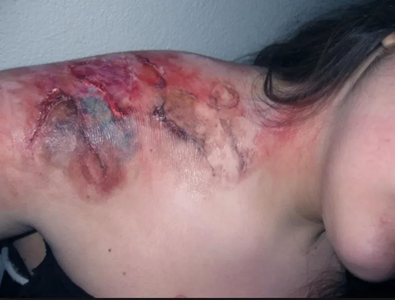 Identifying the common causes of necrotizing fasciitis