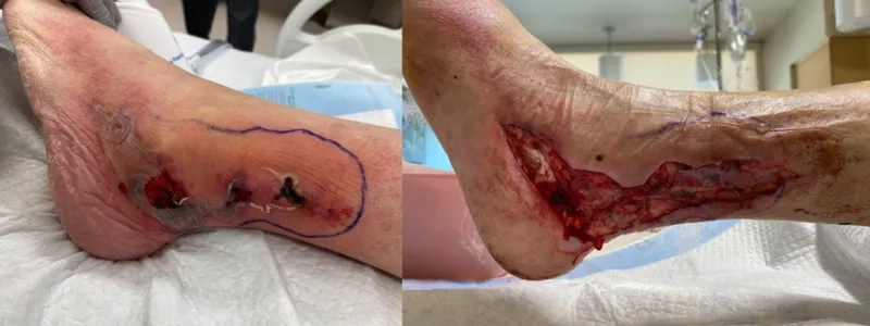 Recognizing the early signs of necrotizing fasciitis