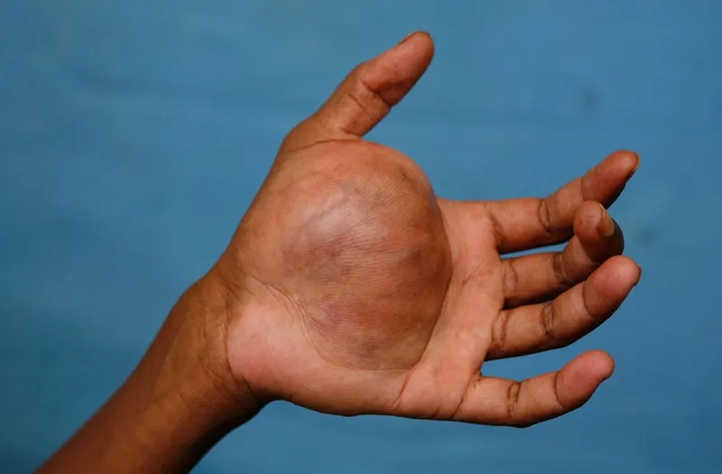 Schwannomatosis and tumor-related health issues