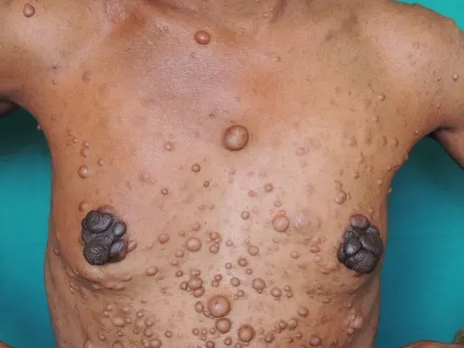 Neurofibromatosis symptoms and health indicators