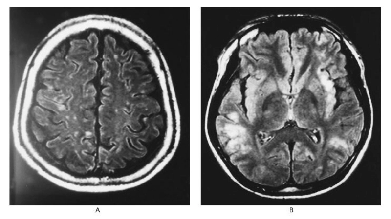Accurate Nipah virus encephalitis diagnosis matters