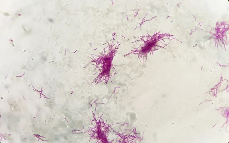 Patient care for nocardiosis in immunocompromised hosts