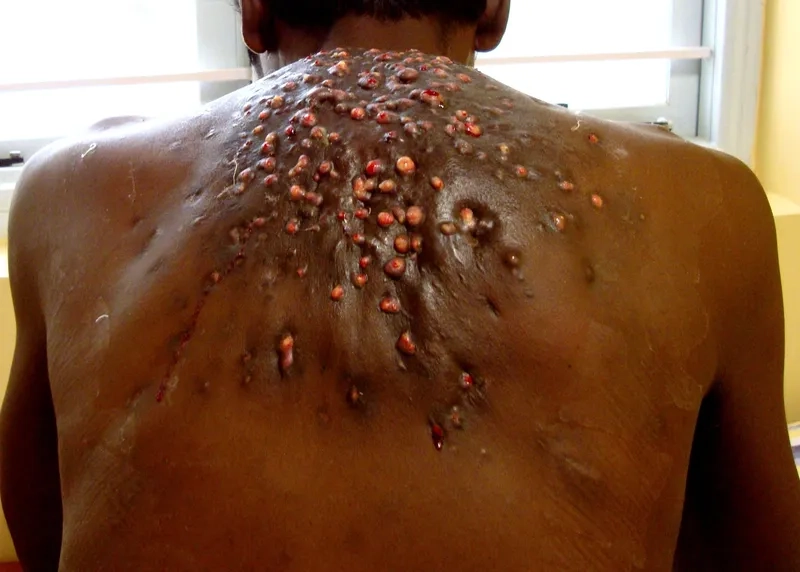 Key steps in the clinical diagnosis of nocardiosis