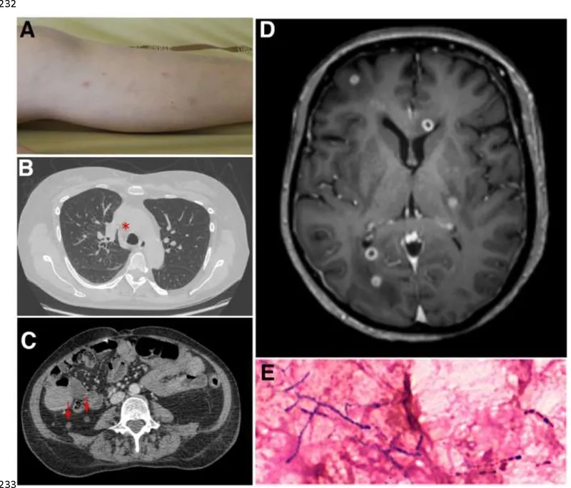 Chest X-ray showing signs of pulmonary nocardiosis