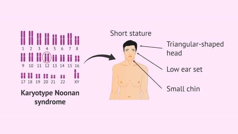 Noonan syndrome genetics and inheritance