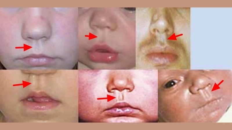 Noonan syndrome in adults health outlook