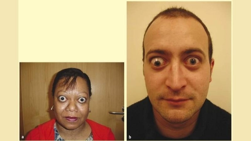 Noonan syndrome facial features characteristics