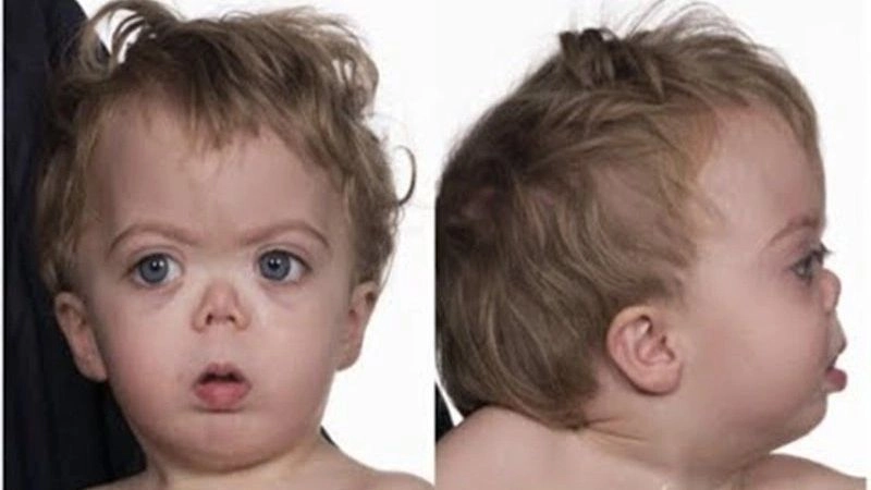 Living with Noonan syndrome daily challenges