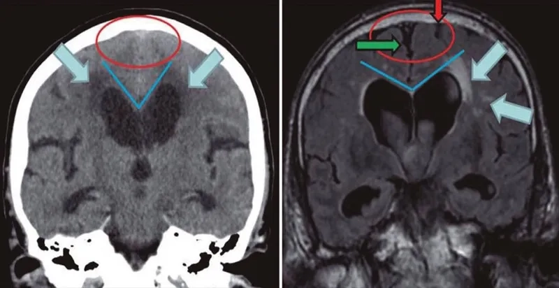 Comparing NPH to other forms of dementia