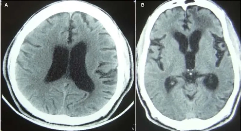 Understanding hydrocephalus in adults