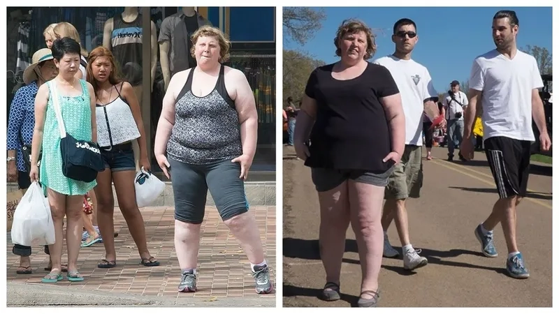 Bariatric surgery and long term weight solutions