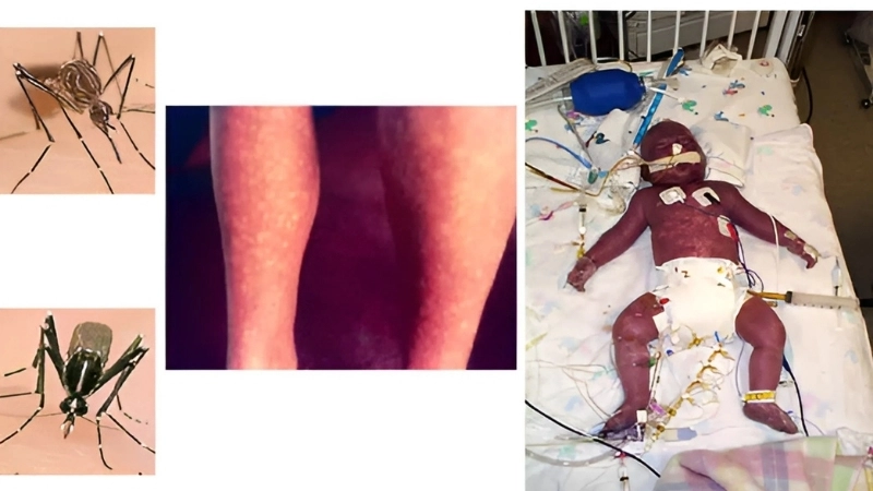 Track the latest Omsk Hemorrhagic Fever outbreak globally today