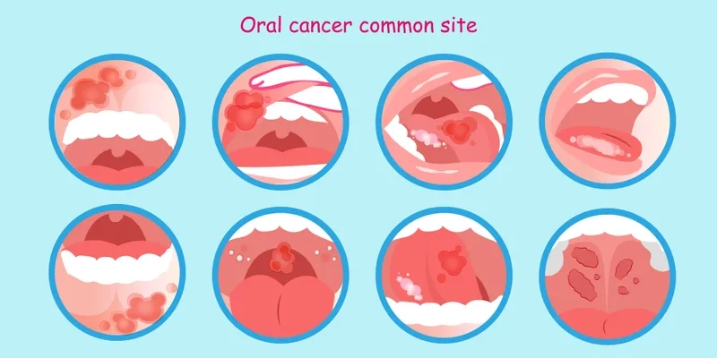 Clinical oral cancer pictures for awareness