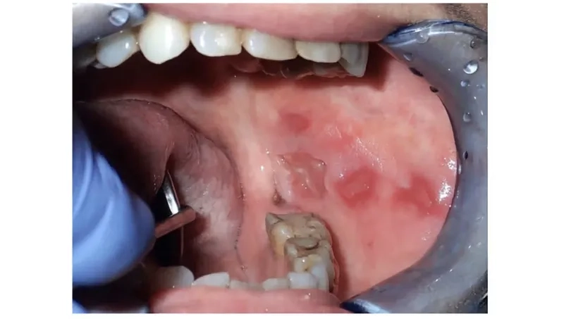 What is oral cancer explained visually