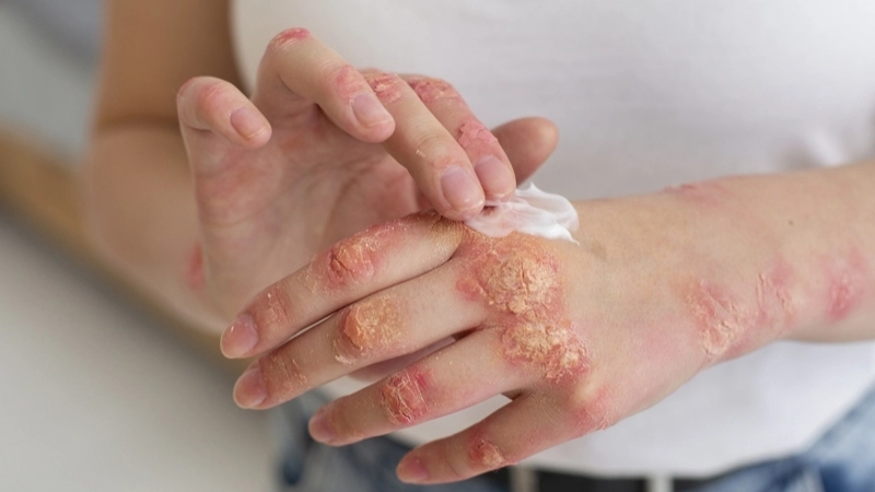 Orf contagious ecthyma orf treatment options