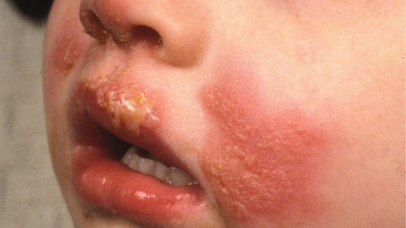 Orf contagious ecthyma orf symptoms in detail