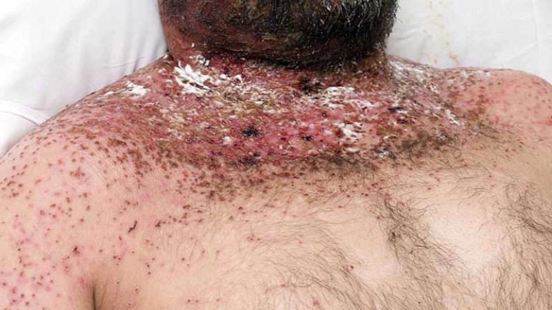 Orf contagious ecthyma contagious ecthyma transmission