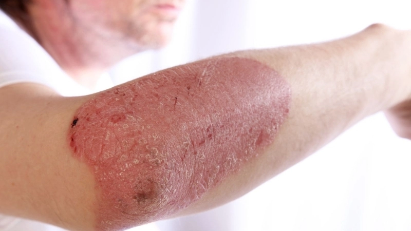 Orf contagious ecthyma orf vaccine research