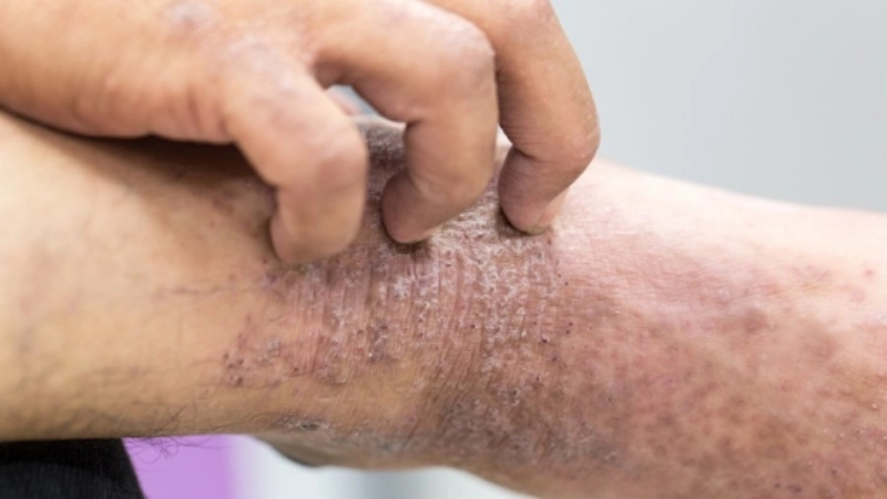 Orf contagious ecthyma zoonotic diseases from animals