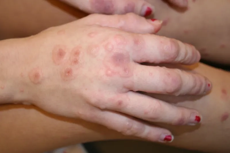 The distinct stages of an orf virus lesion