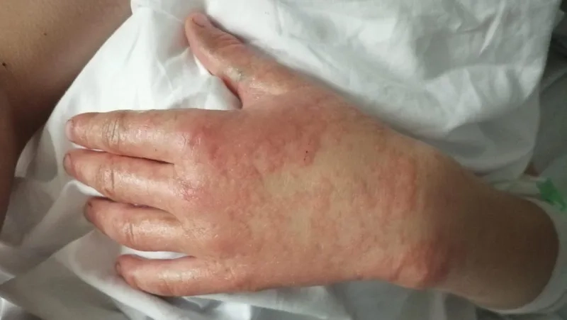 A close-up of a contagious ecthyma lesion