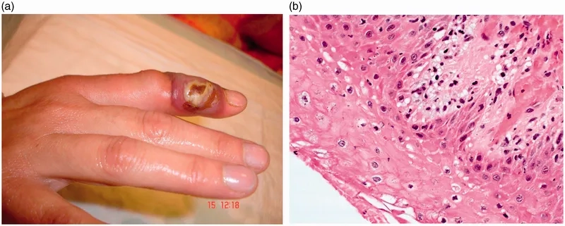 Is orf contagious? Understanding transmission