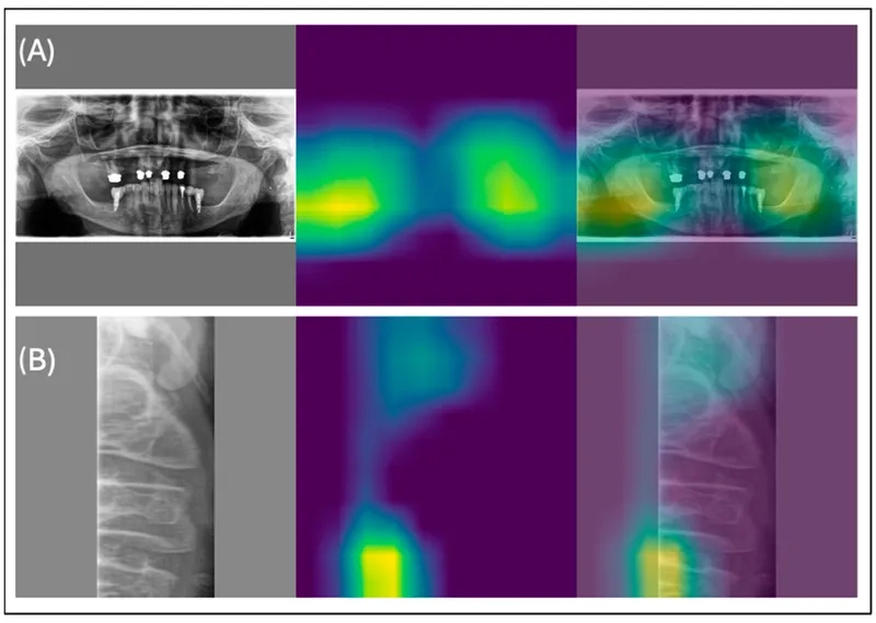 Recognizing osteopenia as an early bone health concern