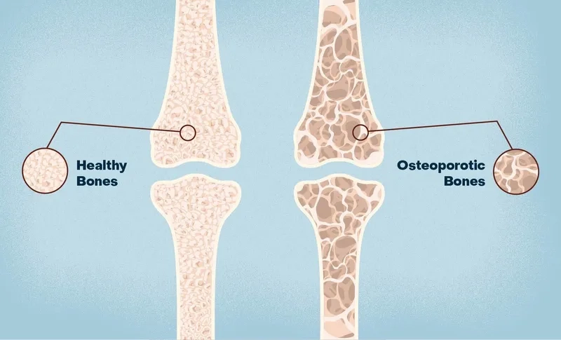 Bone density test for accurate osteoporosis screening