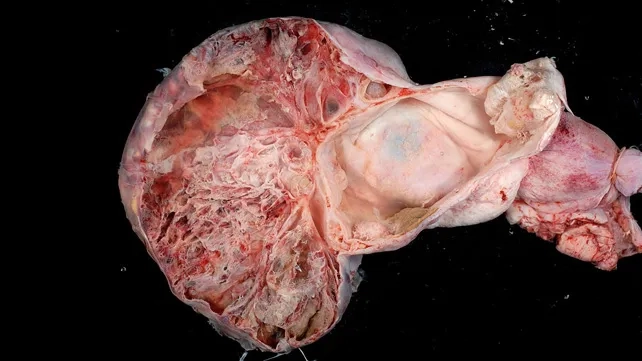 Bloating ovarian cancer warning sign in women