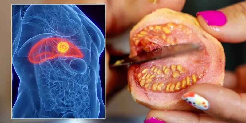 Ovarian cancer survival rate statistics and outlook