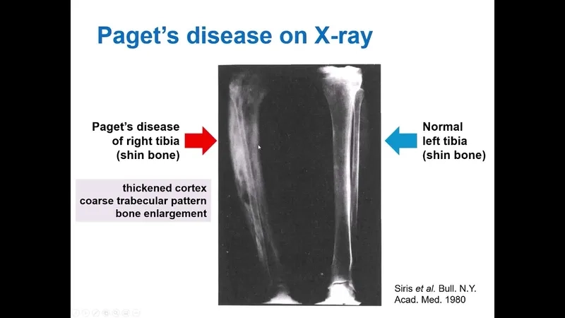 A blood test tube showing high alkaline phosphatase