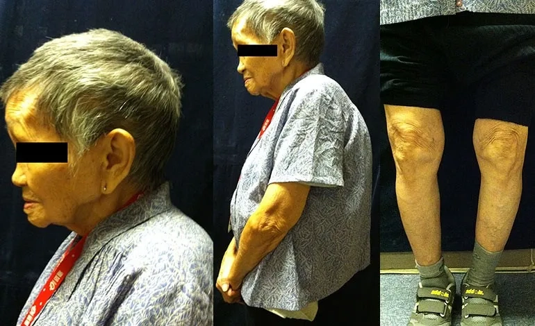 An image of bisphosphonates medication for treatment