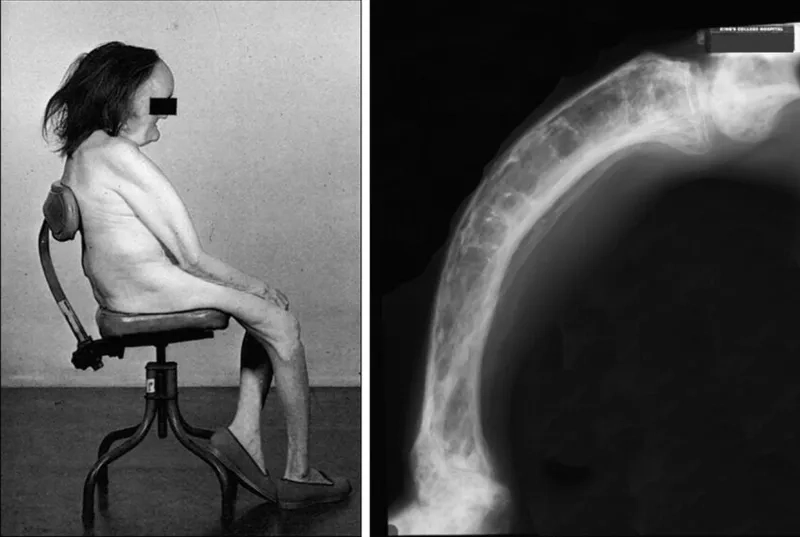 An X-ray showing bone changes from Paget's disease