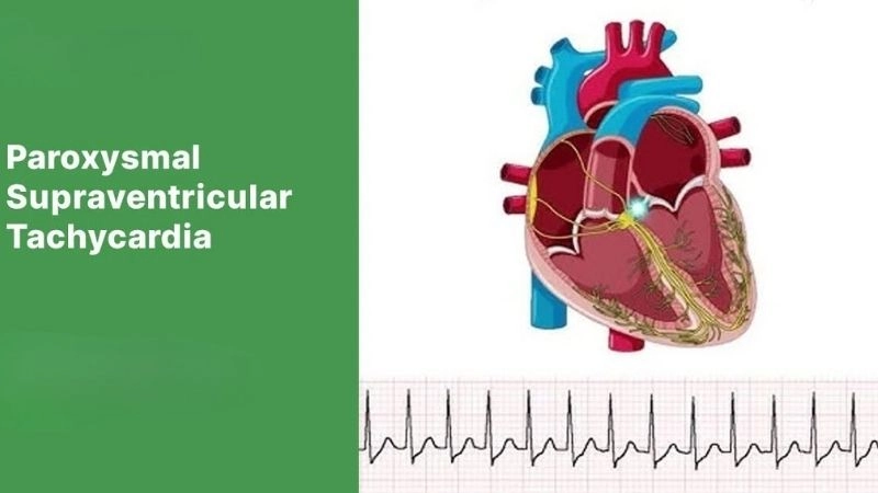 PSVT treatment helps control episodes and restore steady rhythm