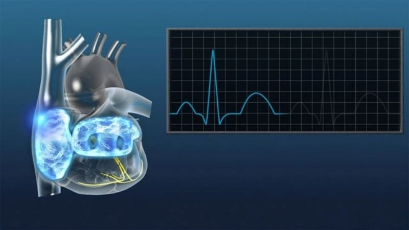 PSVT and pregnancy require careful heart management for safety