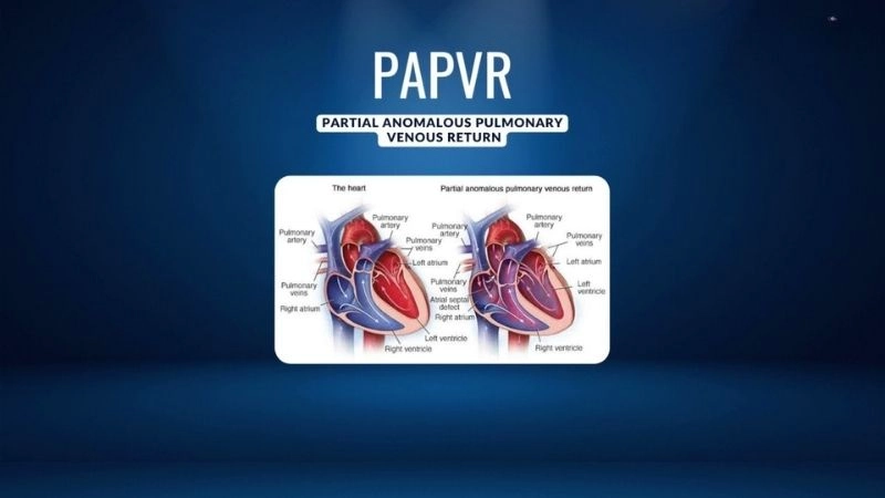 Partial anomalous pulmonary venous return diagnosis explained